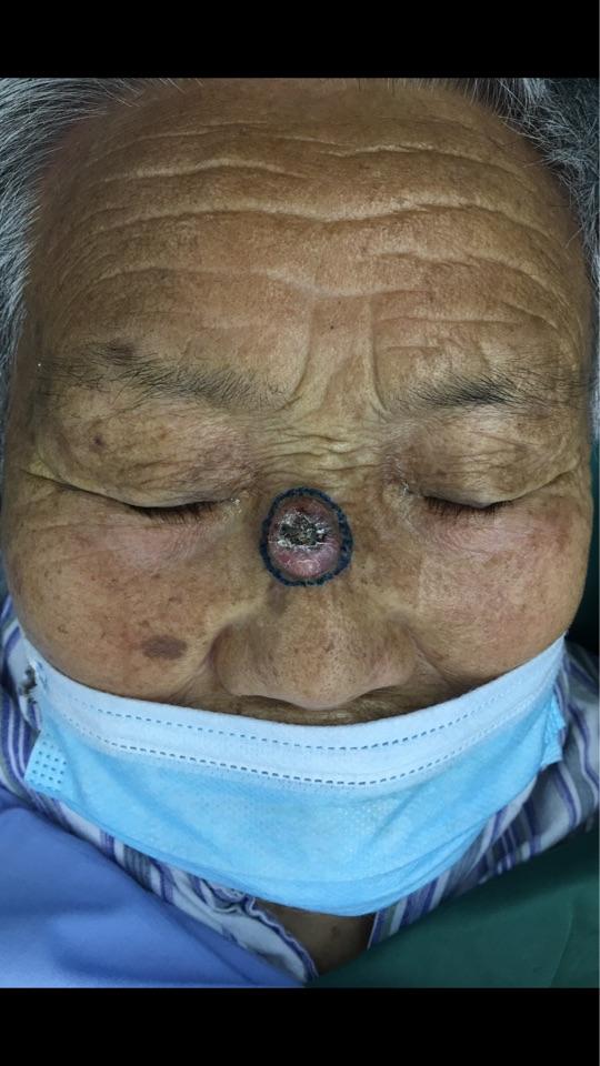 鼻子皮肤癌图片图片