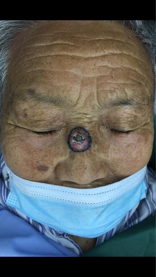 面部皮肤癌的整形美容修复