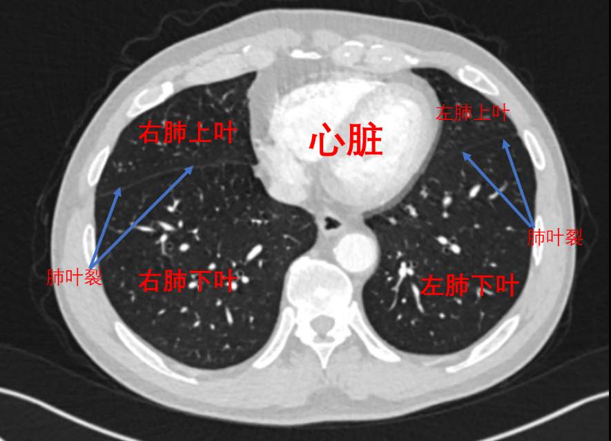 肺叶分段ct示意图ppt图片