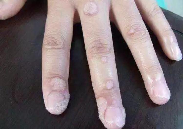 宝宝长了瘊子怎么办谈谈儿童病毒疣