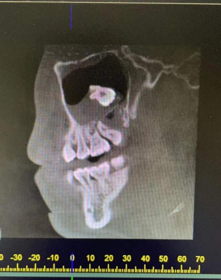 牙根进入上颌窦怎么办?_王方圆医生文章_同济大学附属口腔医院-微医