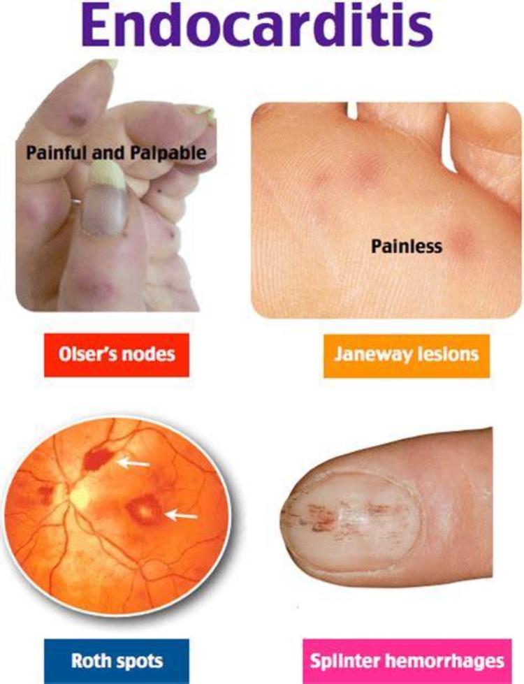 皮肤栓塞可见散在的小瘀点,指趾屈面可有隆起的紫红色小结节,即osler