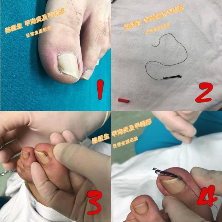 嵌甲的无创治疗挂线法