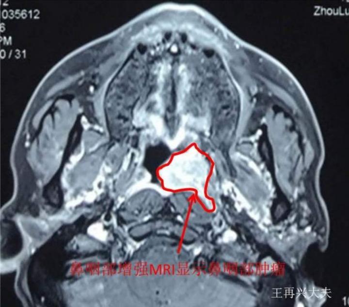 广东癌科普之二排除鼻咽癌我们需要检查什么