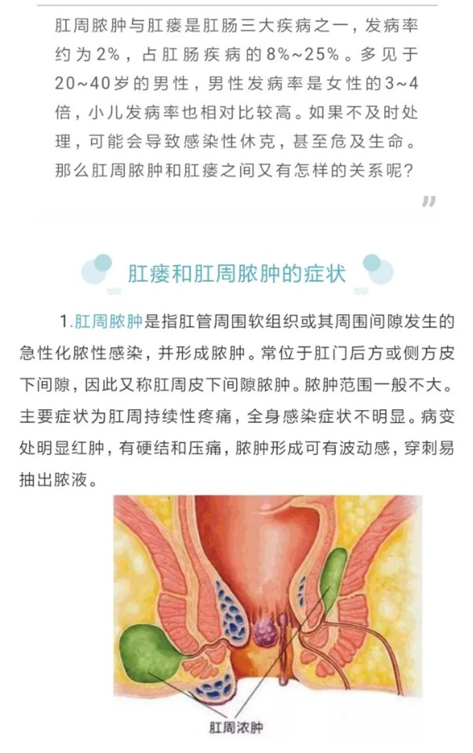 帶您認識肛周膿腫與肛瘻