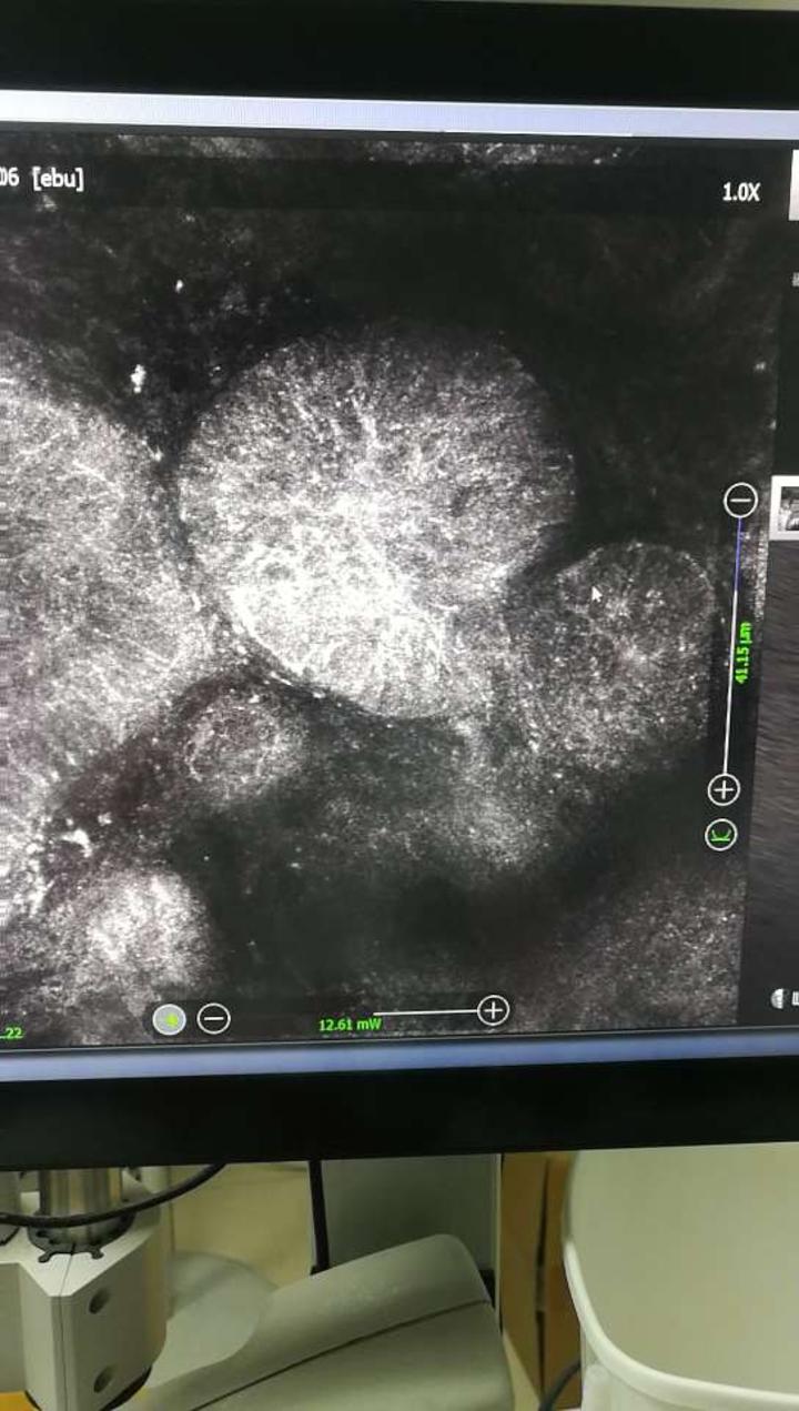 领先,采用无创皮肤ct,影像呈基底层大量拉长的极性基底细胞呈轮辐状