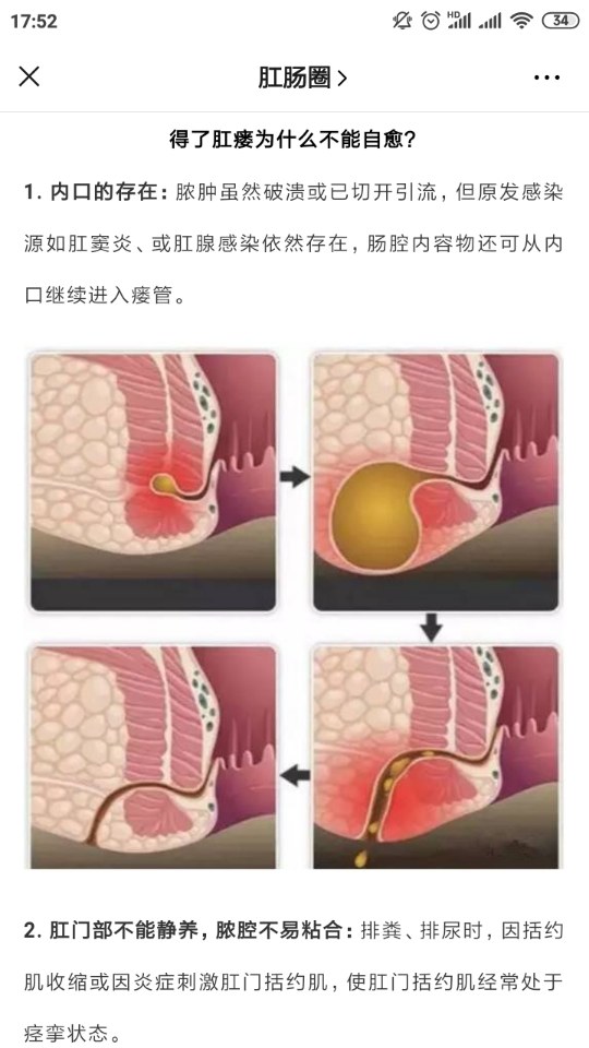 为什么肛瘘不能自愈