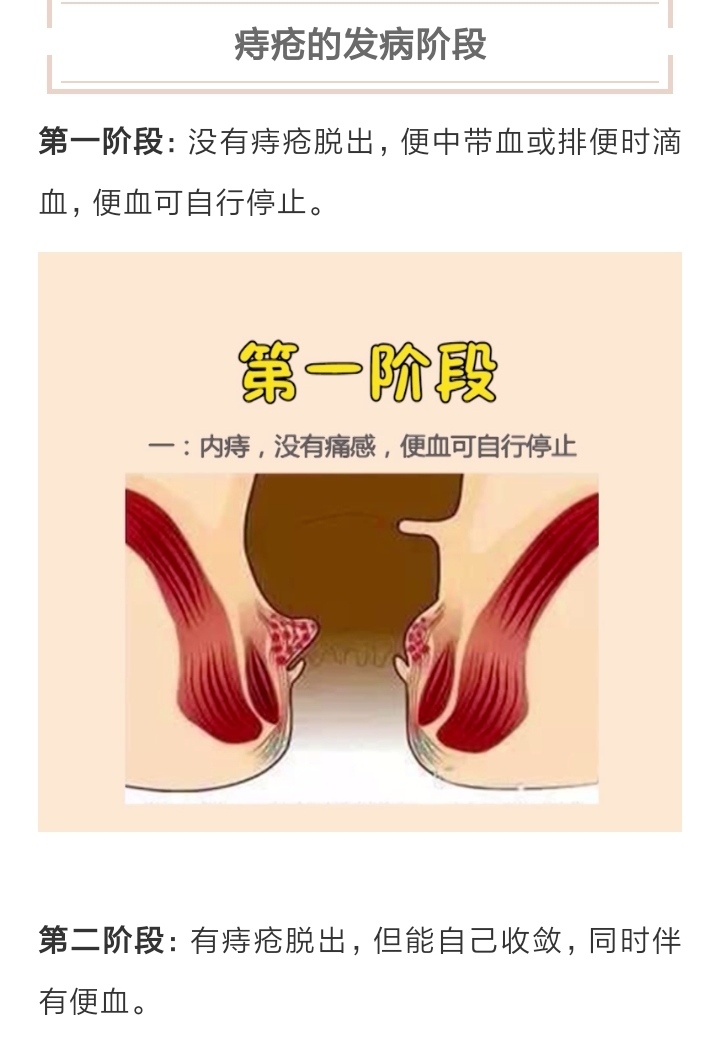 内痔脱出 女性图片