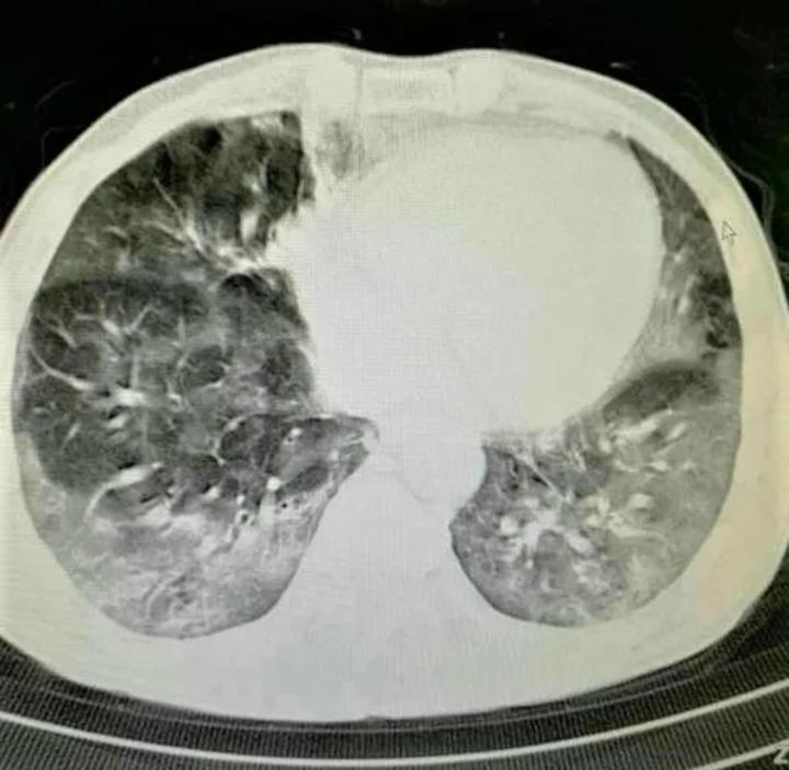 上消化道刺激腐蚀,肝和(或)肾损害,随后出现肺部损伤,肺组织纤维化
