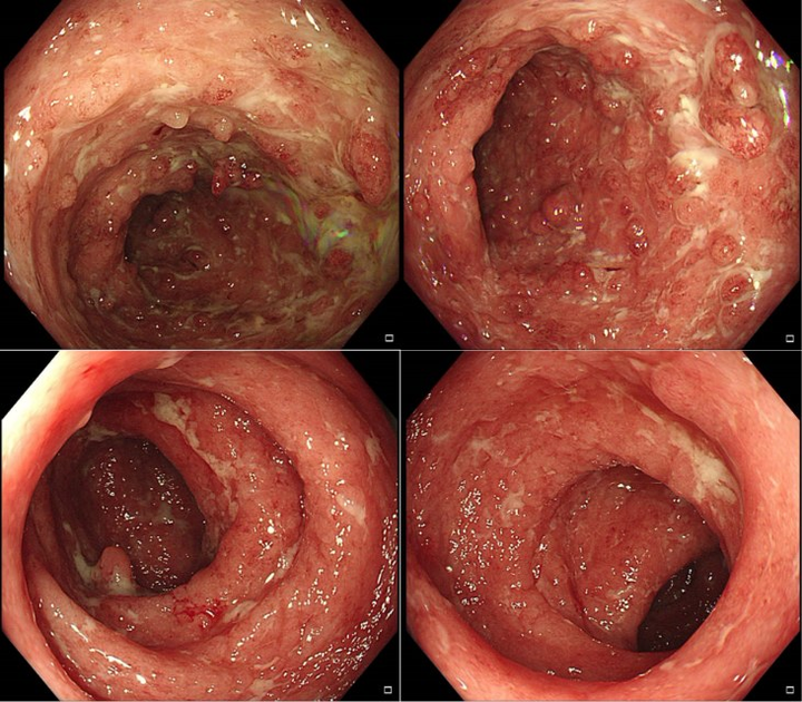 青玉散成功治愈中重度全结肠型溃疡性结肠炎又一例