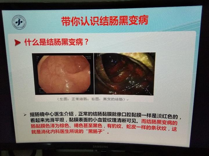 帶你認識結腸黑變病的臨床表現及治療上