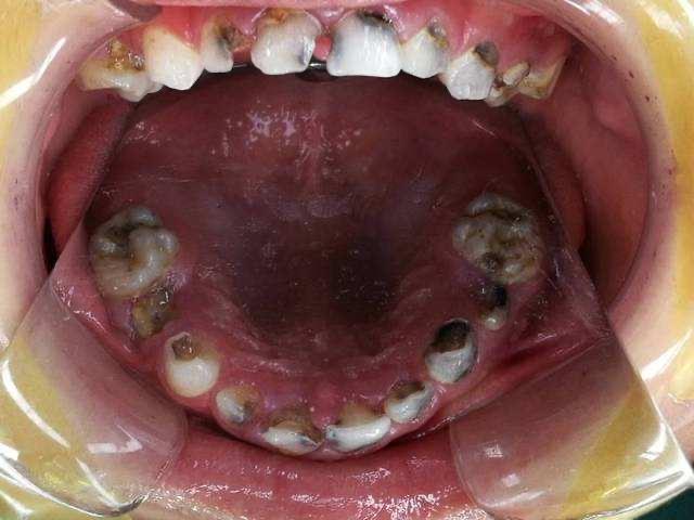 婴幼儿牙齿奶龋齿图片图片