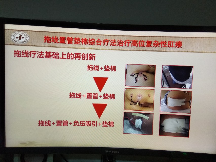 枫泾医院肛肠科特色手术方法介绍拖线置管垫棉综合疗法治疗高位复杂性