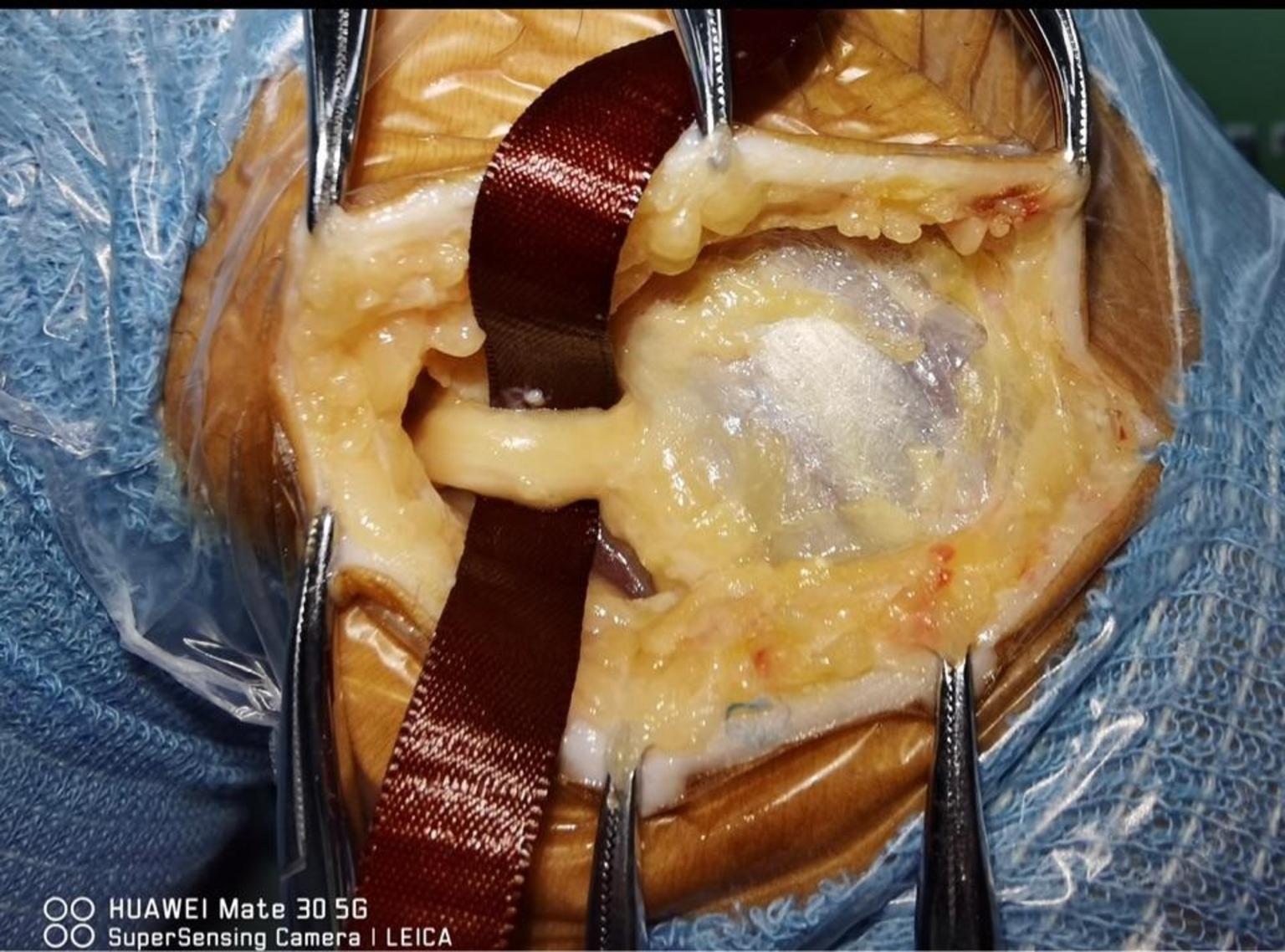 腓总神经卡压综合征