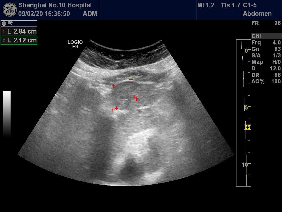 转移性肝癌超声图片图片