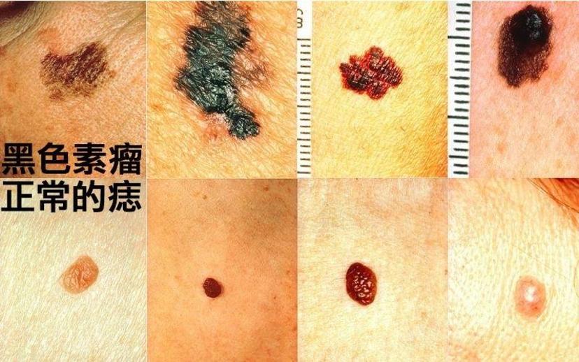 痣(nevue)在医学上称作痣细胞或黑素细胞痣,是表皮,真皮内