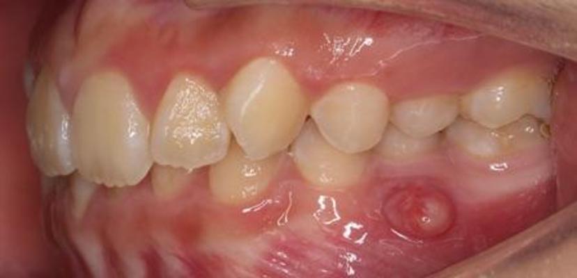 畸形中央尖的处理