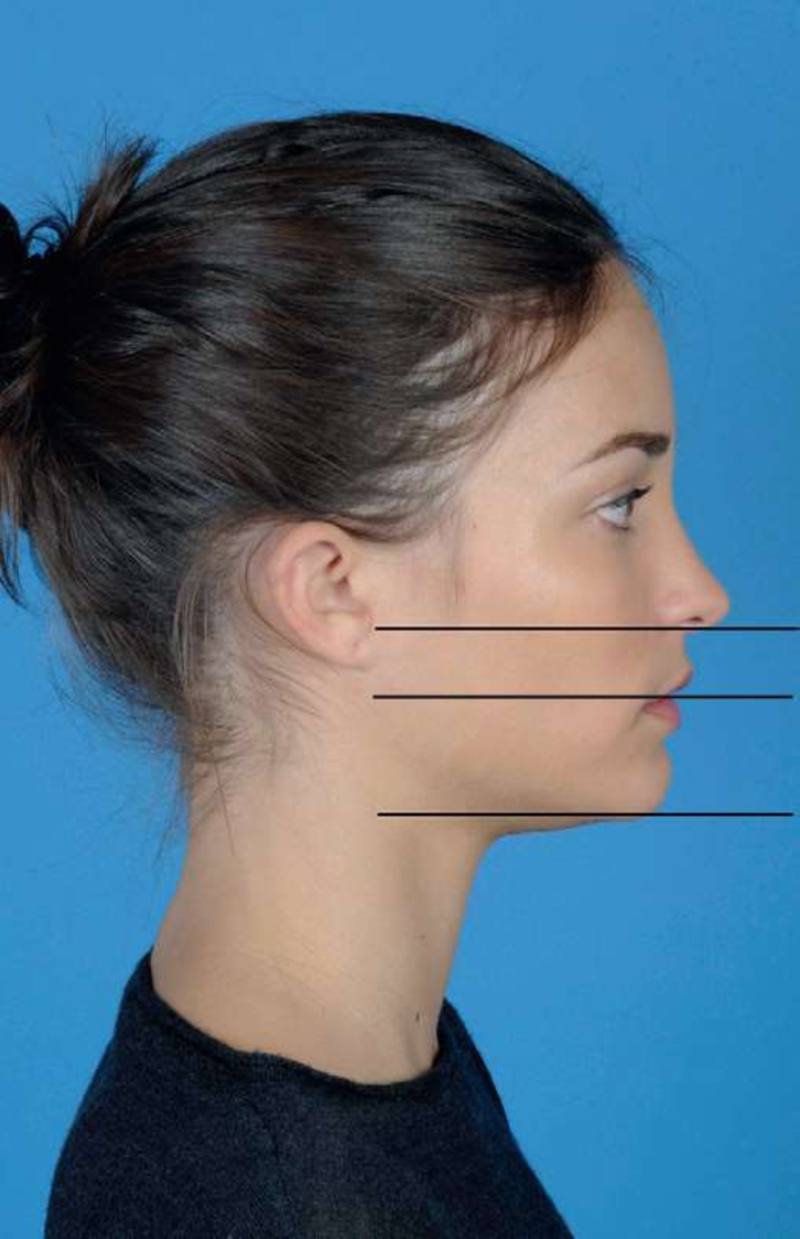 颏部下巴美学设计要点以及常用治疗方案附案例图