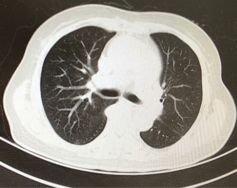 病例展示系列3复张性肺水肿