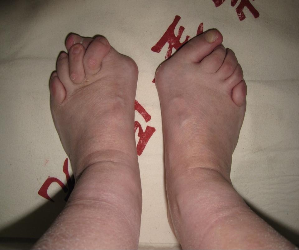 脚的这种变形临床上称为踇外翻