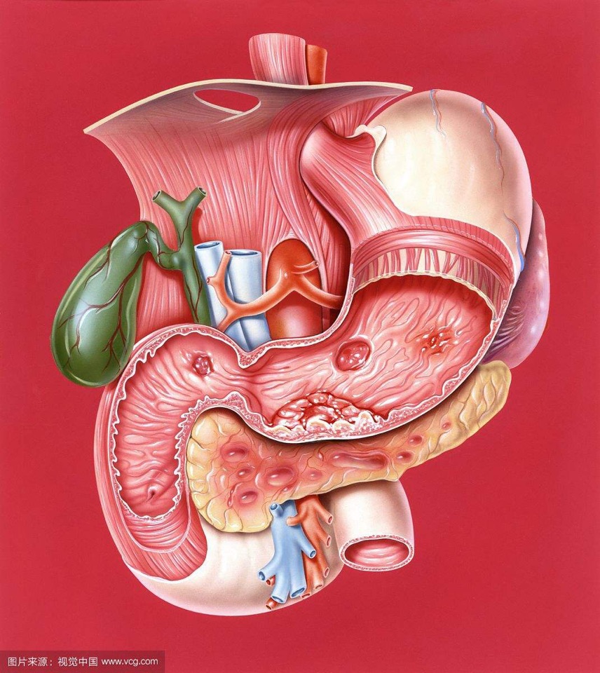 消化疾病科普——消化性溃疡