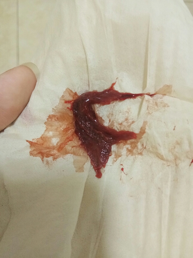 想知道经血中不是血块的块状物是什么