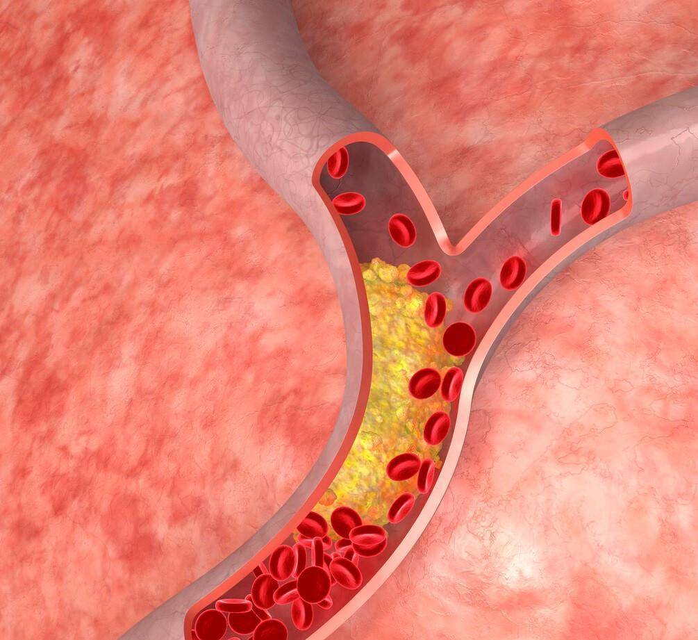 如何预防颈动脉斑块脱落 - 微医(挂号网)