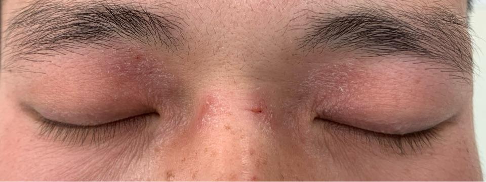 上眼皮发红瘙痒可能是特应性皮炎发作了