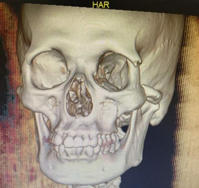 一例眶颧颌骨折的案例