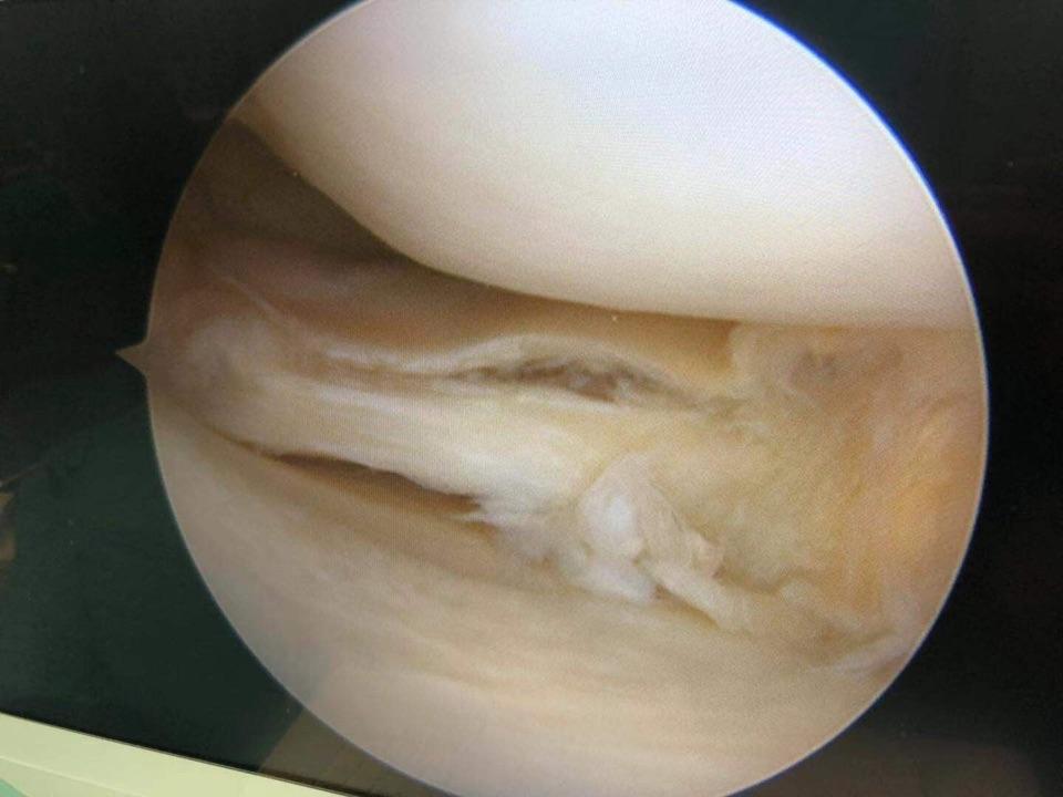 膝盖内侧半月板撕裂