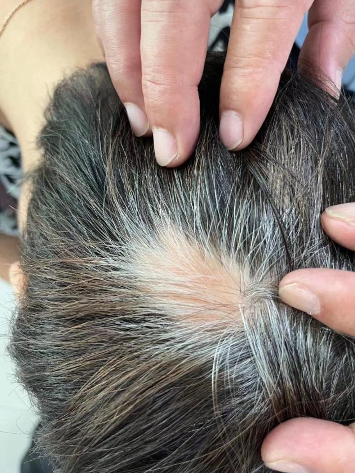 21斑秃圆形脱发中为何脱落的都是黑发