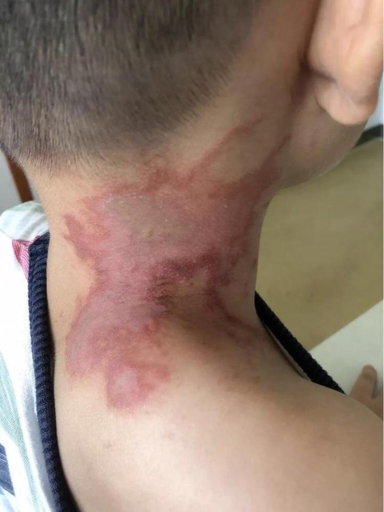 痒痒痒夏天虫咬皮炎扰孩童