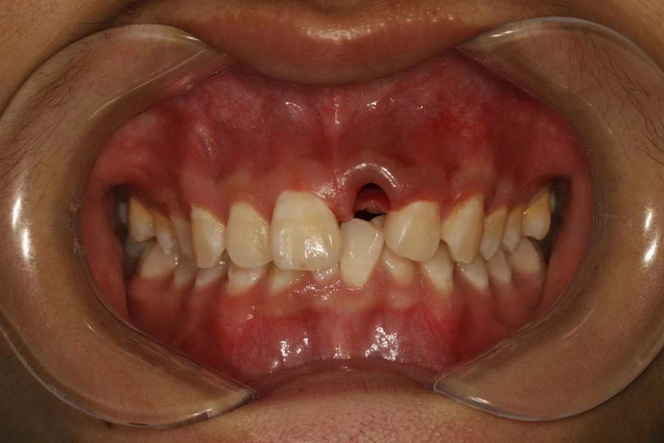 13岁男孩,牙齿完全性脱位,行牙再植术 牙周纤维带固定.