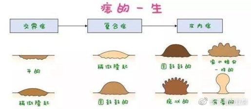 皮內痣:成人常見.