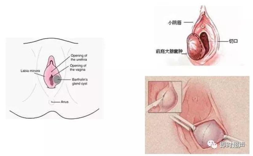 前庭大腺囊肿 健康号 微医