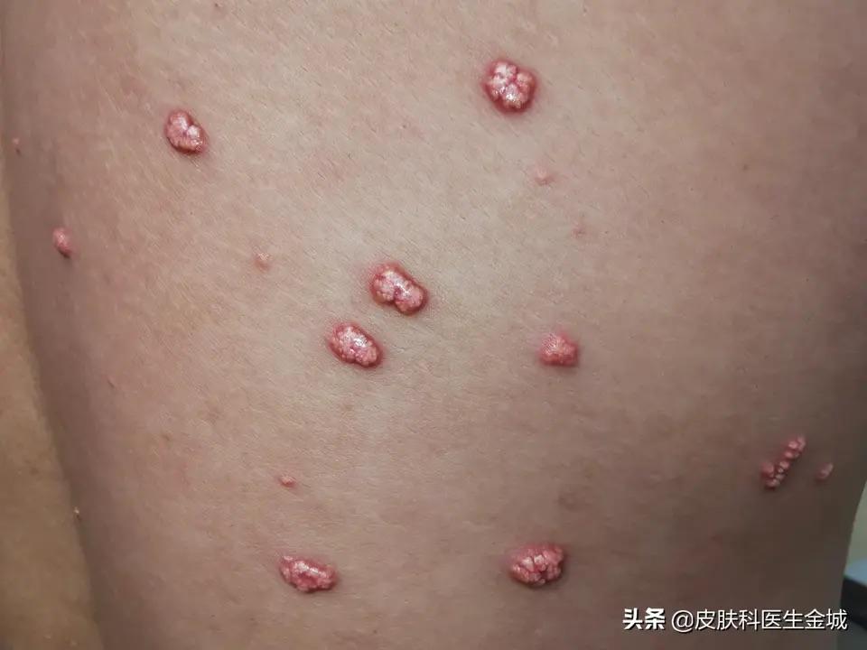 发疹性黄瘤病看上去有点恐怖