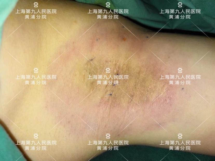 黄金微针治疗腋臭#【一千零一腋】之819 - 微医(挂号网)