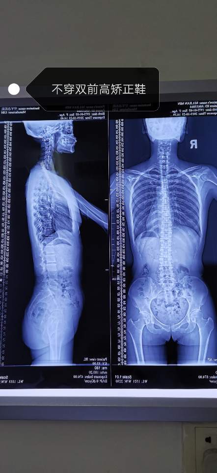 腰脊柱凹陷的图片图片