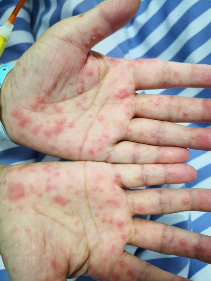 马尔尼菲青霉素病历一例 - 微医(挂号网)