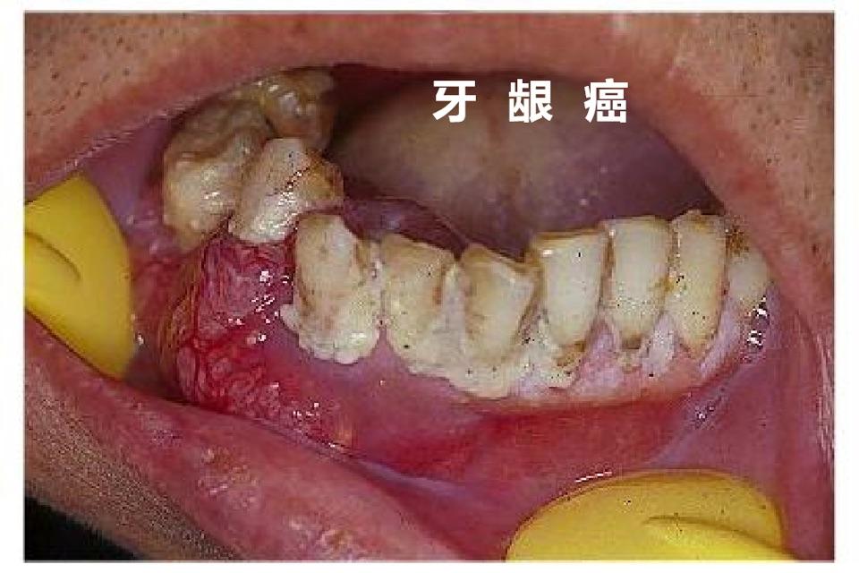 牙龈瘤与牙龈癌 溃疡图片