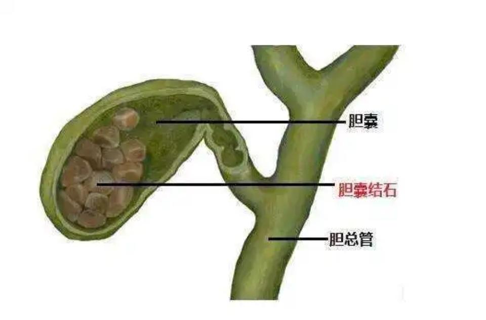 胆囊癌危险因素,如胆囊萎缩,充满型结石,瓷化胆囊,胆囊壁增厚(≥3mm)