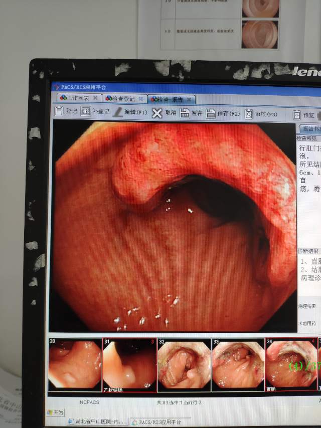 今天做了11个肠镜1个直肠癌6个患有肠息肉