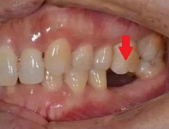 对颌牙伸长这会导致更严重的咬合紊乱及缺牙间隙的丧失,之后想要镶牙