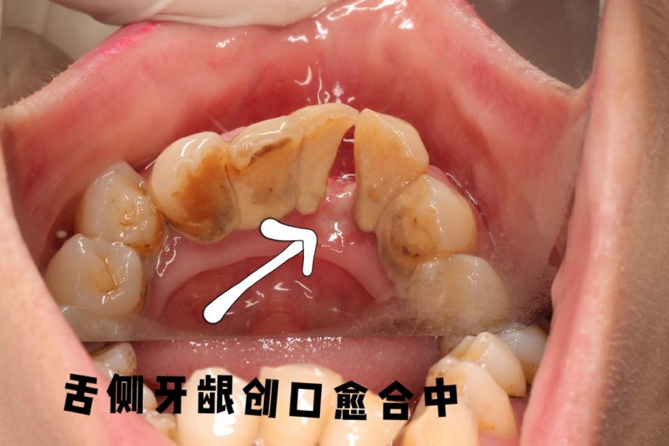 牙龈瘤,门诊手术微创摘除