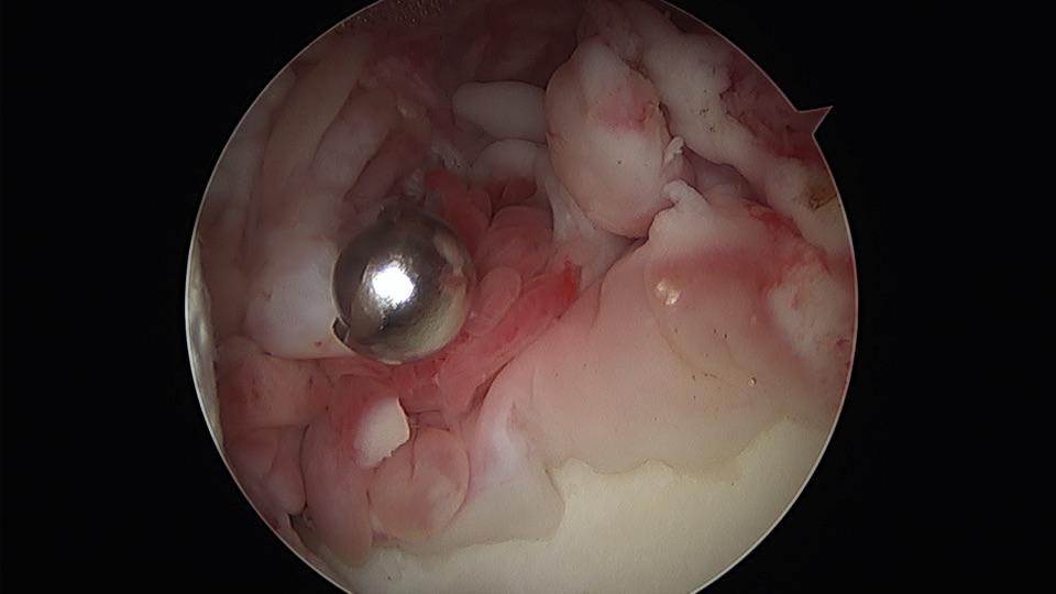 滑膜软骨瘤图片