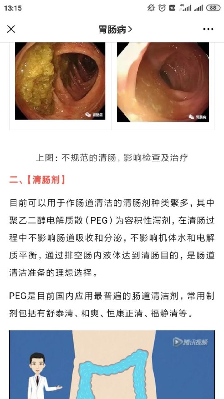 腸鏡檢查如何有效清腸這還真是個技術活