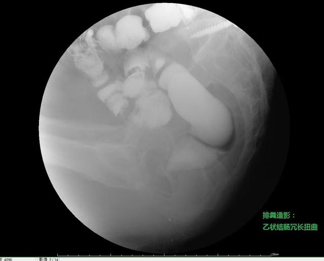 乙状结肠冗长导致顽固性便秘的微创手术