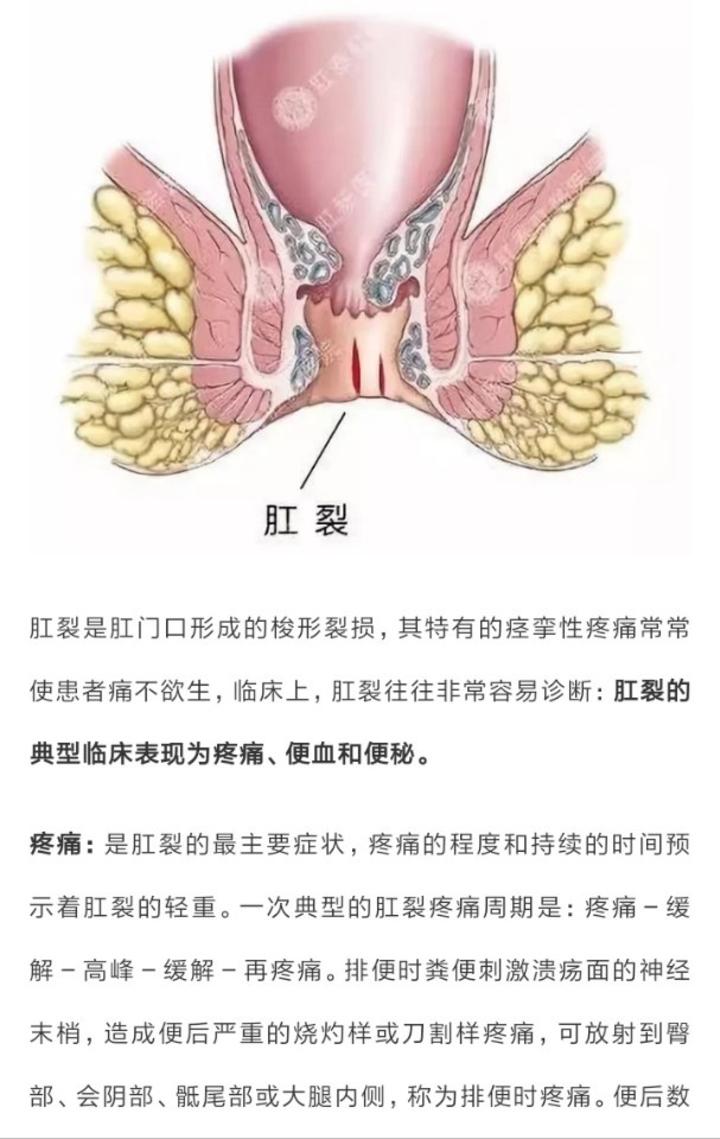 肛裂是否可以自愈术后如何护理