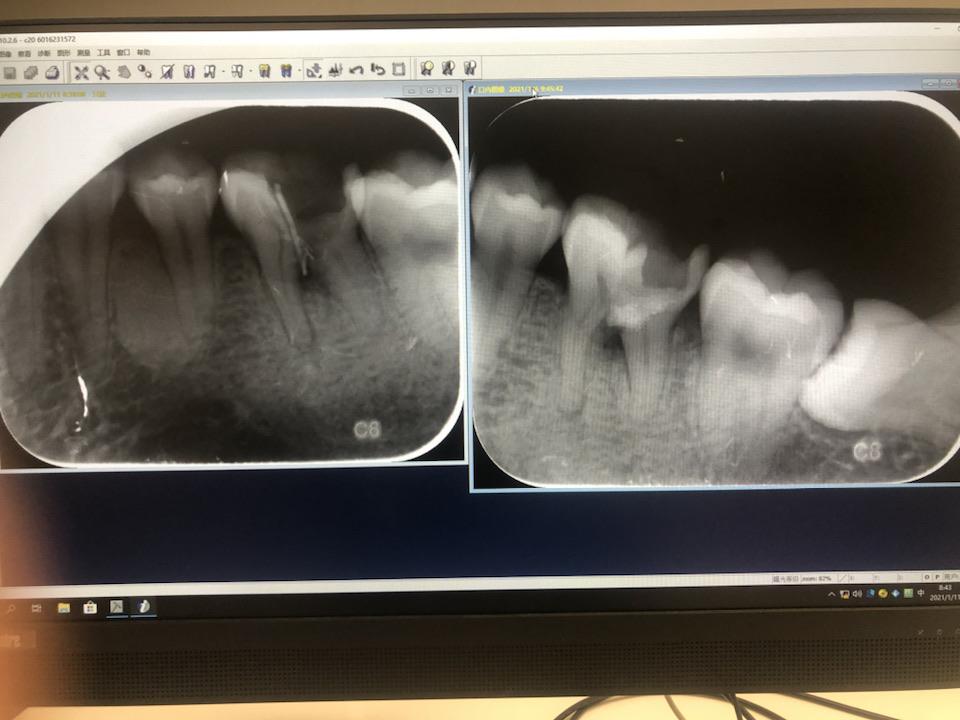 有10年左右,去年补过,补完没有感觉,最近去洗牙发现牙齿牙根有阴影