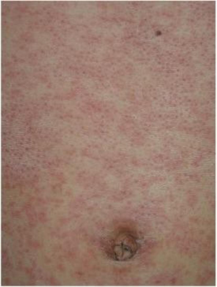 儿童发热又出现皮疹到底是什么病病毒感染篇